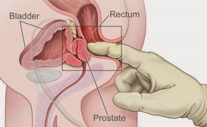 A diagram showing where the prostate is for a man